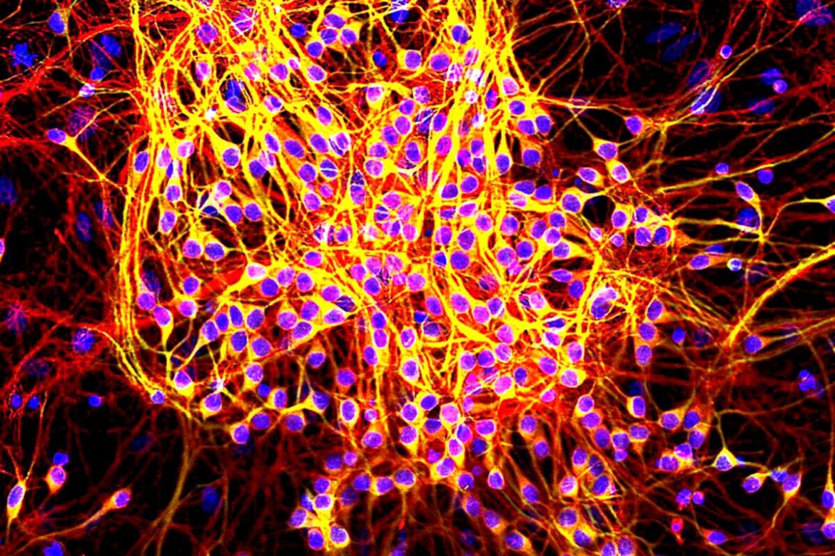 ‘Zinc fingers’ may help treat Alzheimer’s, animal study shows